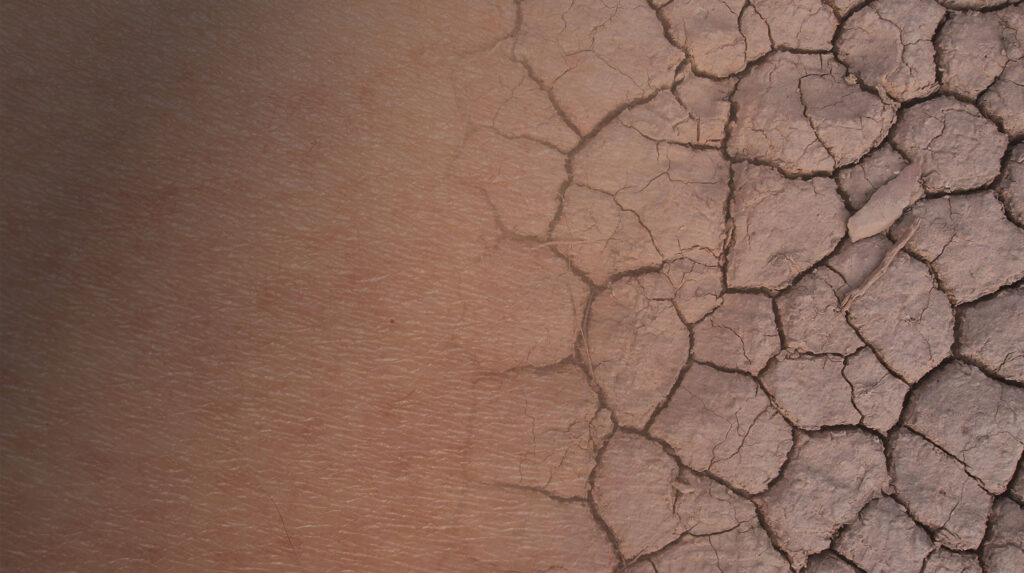 Skin Dehydration