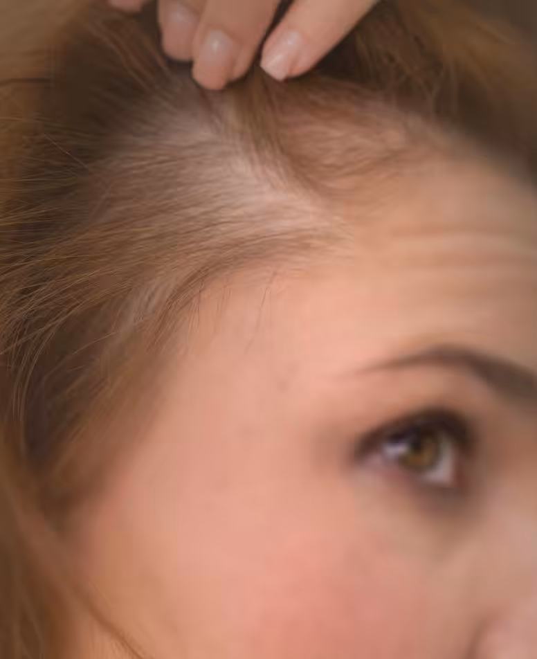 alopekia