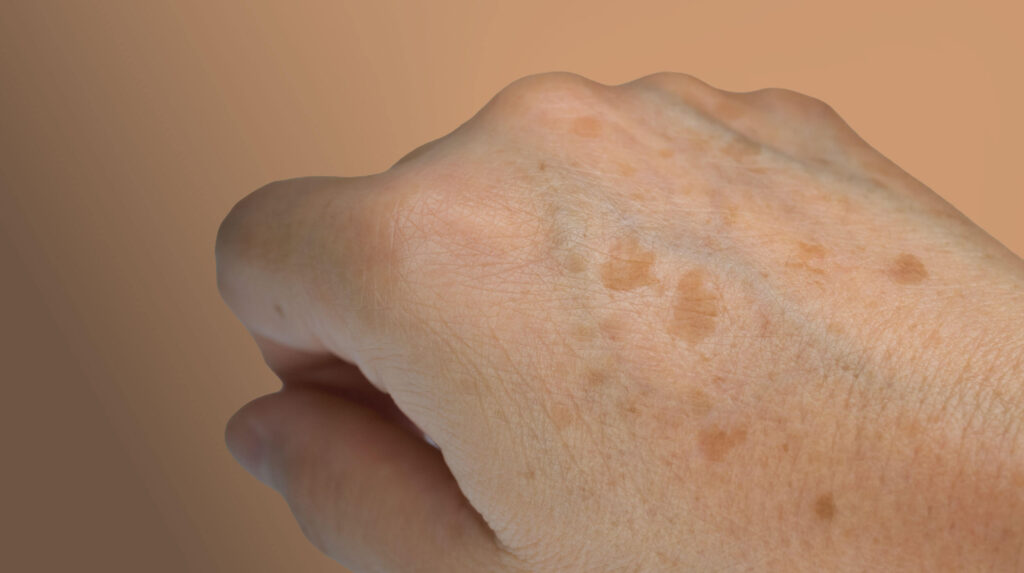 Hand Rejuvenation
