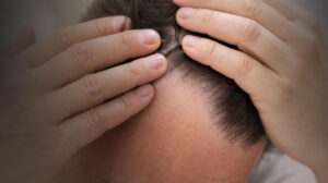 Hair thinning
