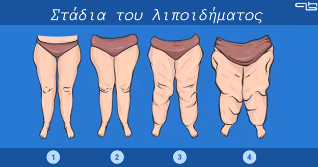 λιποίδημα