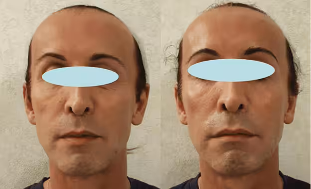 Σύσφιξη και αναδόμηση επιδερμίδας με peeling νέας γενιάς