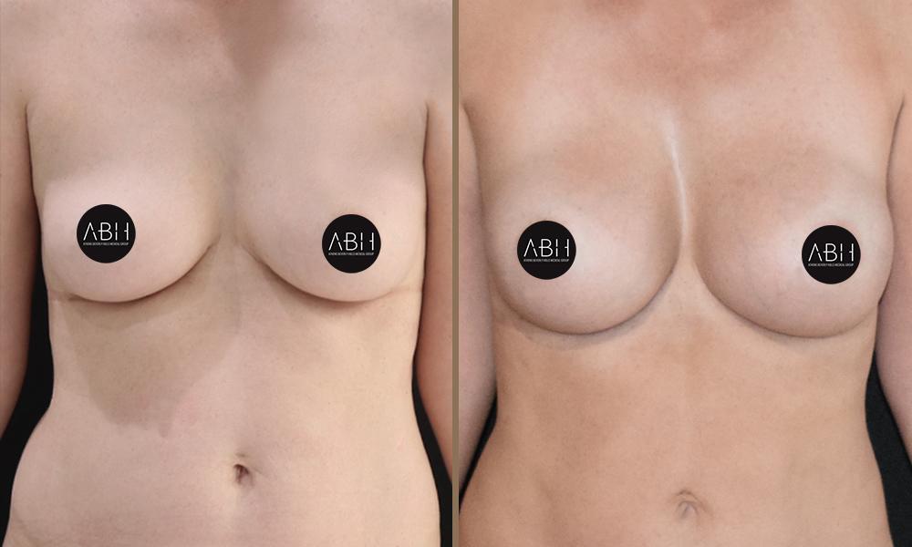 Composite (Hybrid) Breast Augmentation 3 Before & After - Composite (Hybrid) Breast Augmentation