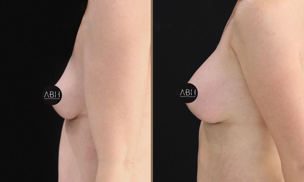 Composite (Hybrid) Breast Augmentation 4 Before & After - Composite (Hybrid) Breast Augmentation