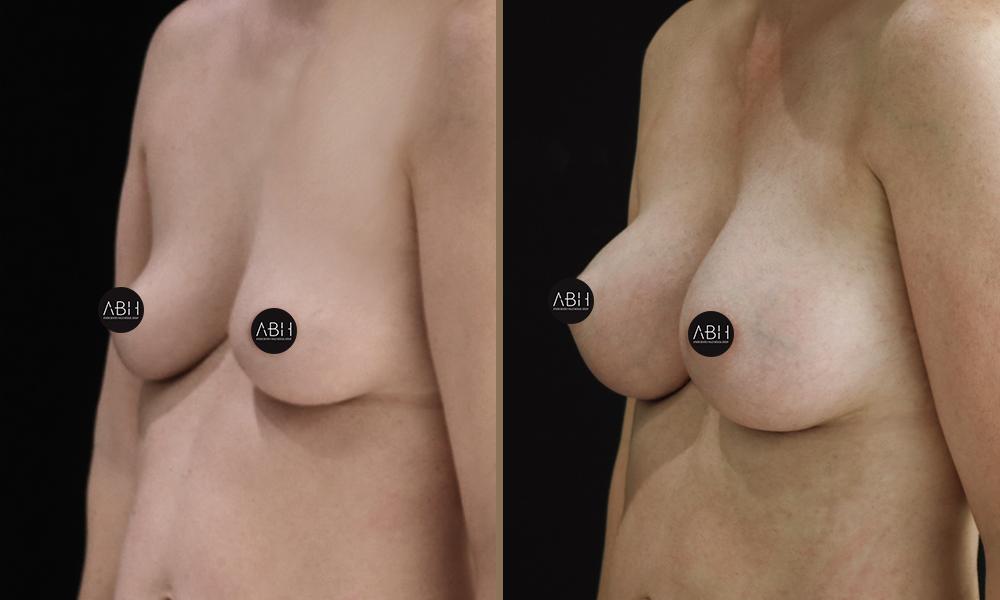Composite (Hybrid) Breast Augmentation 5 Before & After - Composite (Hybrid) Breast Augmentation