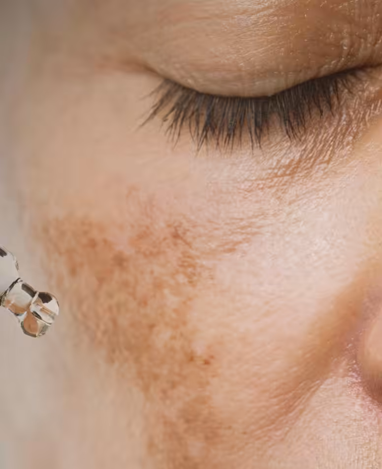 melasma