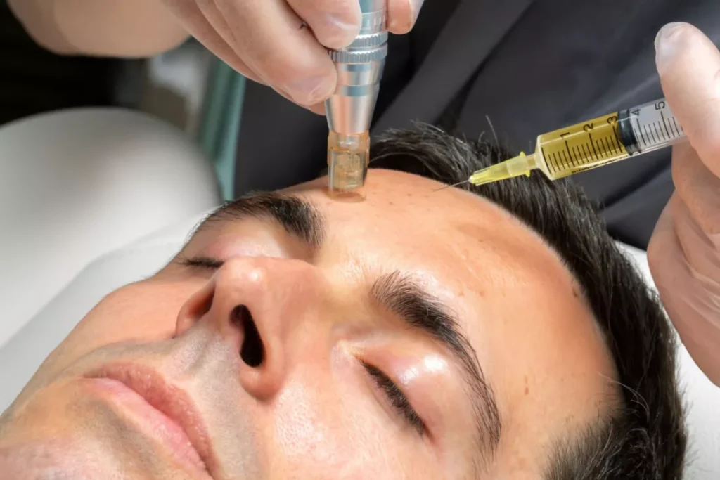 Αυτόλογη Μεσοθεραπεία PRP (Platelet-Rich Plasma)